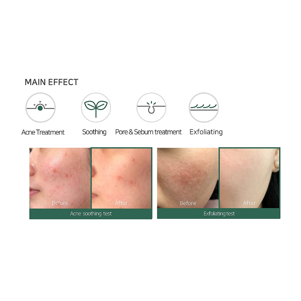 Miracle Acne Clear Foam (100ml)