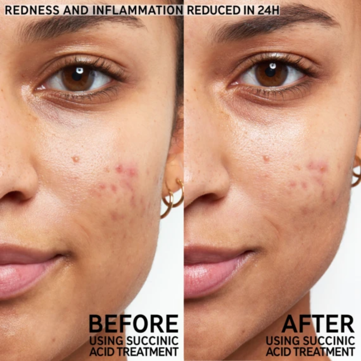 Succinic Acid Blemish Treatment (15ml)